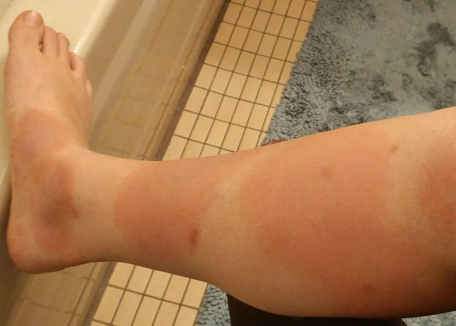 Lyme bullseye rash aka erythema migrans on foot and leg